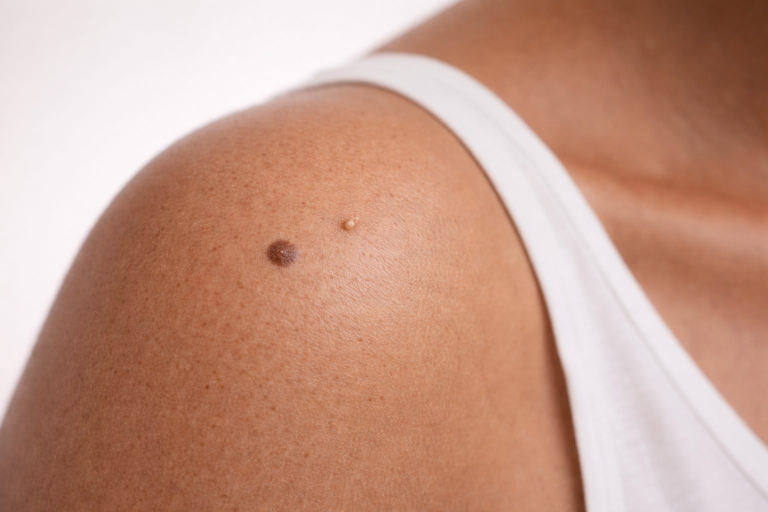 Chirurgie médicoesthétique mineure pour excision de lésion cutanée, Québec | Minor medico-aesthetic surgery for skin lesion excision, Quebec Lésion cutanée sur l'épaule avant chirurgie médicoesthétique mineure à la clinique Le Centre au Québec | Skin lesion on the shoulder before minor medico-aesthetic surgery at Le Centre clinic in Quebec