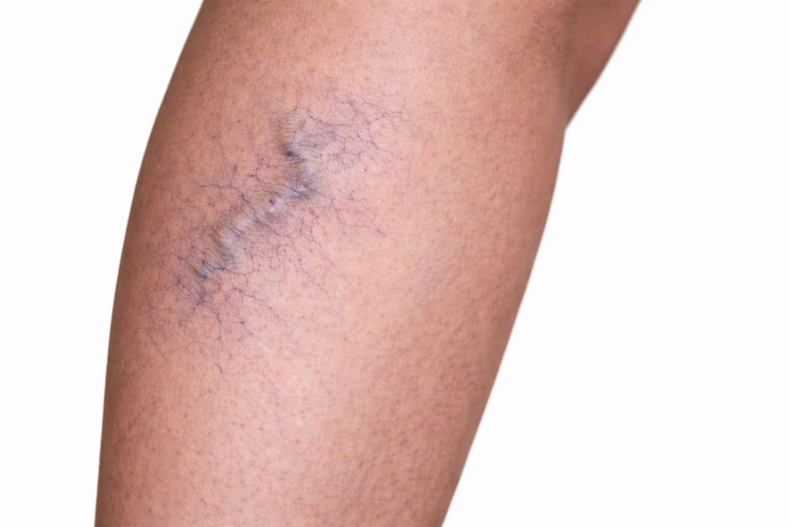 Échosclérose guidée par ultrasons pour varices des jambes, Québec | Ultrasound-guided echosclerotherapy for leg varicose veins, Quebec Varices visibles sur la jambe avant échosclérose guidée par ultrasons à la clinique Le Centre au Québec | Visible leg varicose veins before ultrasound-guided echosclerotherapy at Le Centre clinic in Quebec
