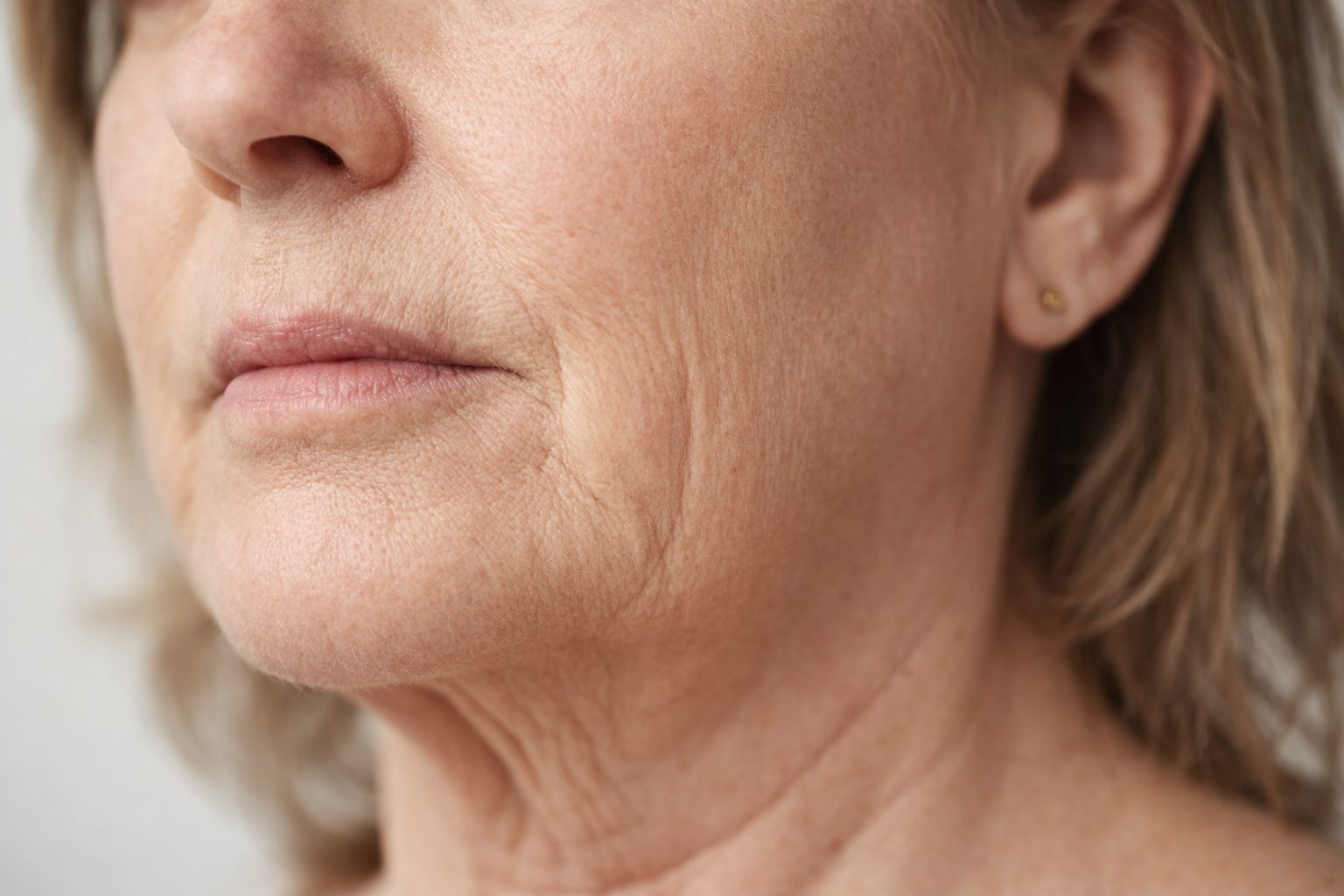 Fils tenseurs pour relâchement du cou et des bajoues, Québec | Thread lift for neck and jowl laxity, Quebec Relâchement du bas du visage, du cou et des bajoues avant traitement par fils tenseurs à la clinique Le Centre au Québec | Lower face, neck and jowl laxity before thread lift treatment at Le Centre clinic in Quebec