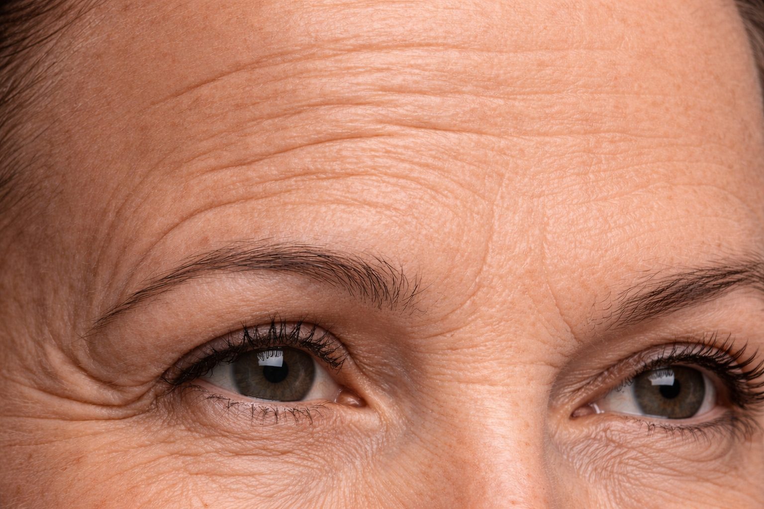 Injection de neuromodulateurs Botox Dysport pour rides du front et pattes d'oie, Québec | Neuromodulator injection Botox Dysport for forehead lines and crow's feet, Quebec Rides du front et pattes d'oie avant traitement par injection de neuromodulateurs à la clinique Le Centre au Québec | Forehead lines and crow's feet before neuromodulator injection treatment at Le Centre clinic in Quebec