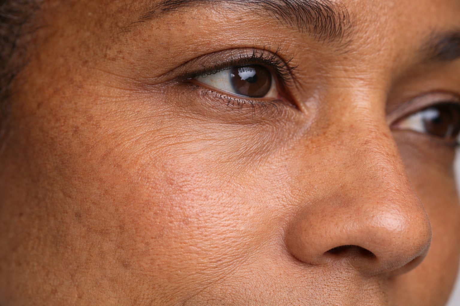 Injection PRP pour régénération de la peau et contour des yeux, Québec | PRP injection for skin regeneration and under-eye area, Quebec Peau du contour des yeux avant traitement par plasma riche en plaquettes PRP à la clinique Le Centre au Québec | Under-eye skin before platelet-rich plasma PRP treatment at Le Centre clinic in Quebec