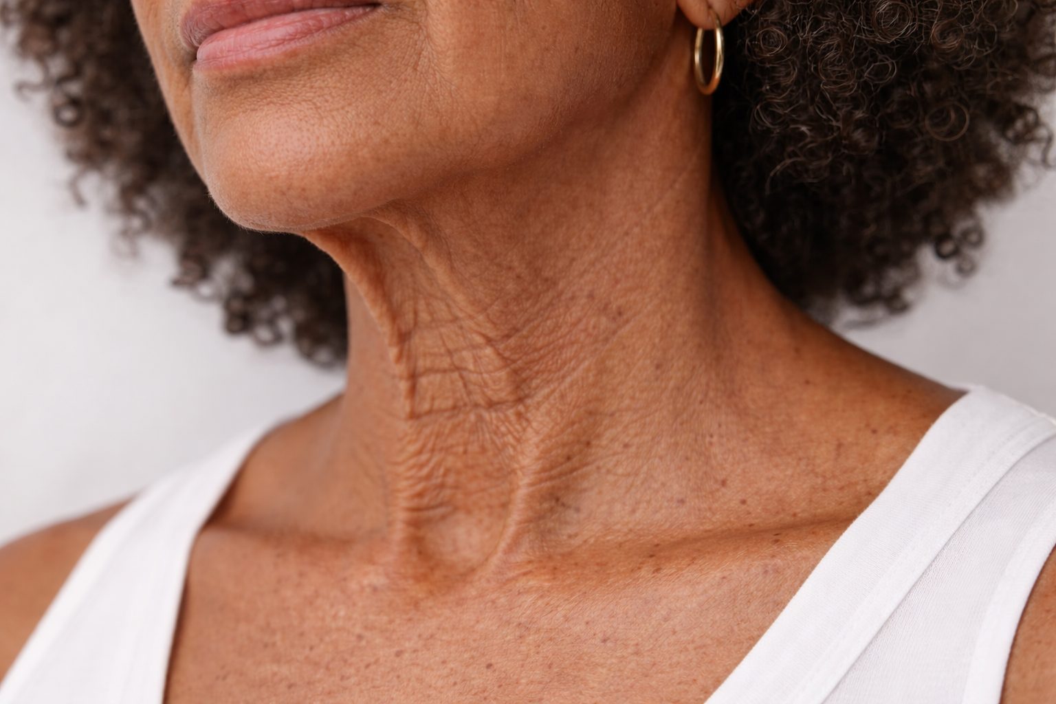 Rajeunissement du cou pour ridules, relâchement et qualité de peau, Québec | Neck rejuvenation for lines, laxity and skin quality, Quebec Ridules, relâchement et texture du cou avant traitement de rajeunissement du cou à la clinique Le Centre au Québec | Neck lines, laxity and skin texture before neck rejuvenation treatment at Le Centre clinic in Quebec