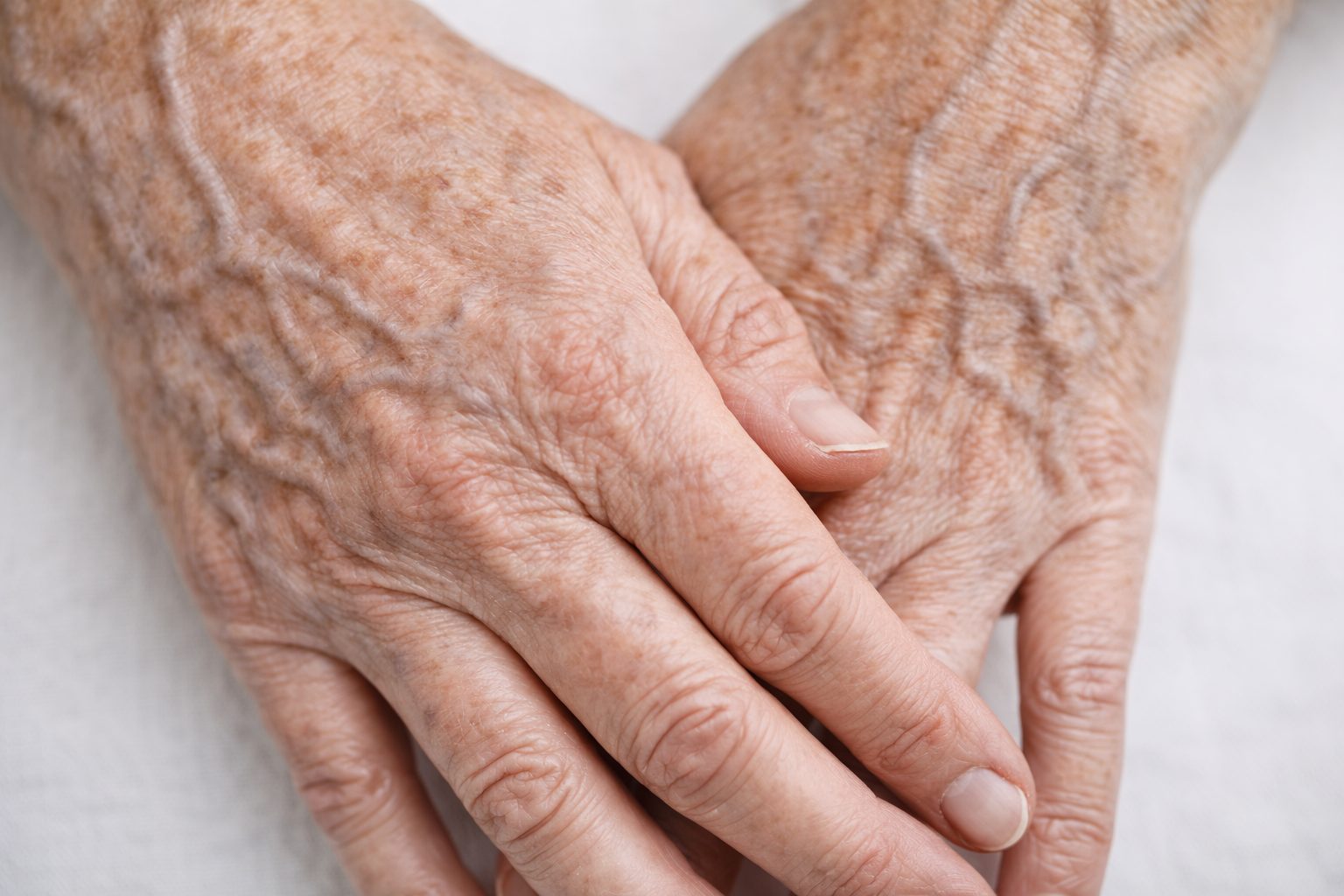 Rajeunissement des mains pour taches, volume et qualité de peau, Québec | Hand rejuvenation for spots, volume and skin quality, Quebec Mains avec perte de volume, veines visibles et taches avant traitement de rajeunissement des mains à la clinique Le Centre au Québec | Hands with volume loss, visible veins and spots before hand rejuvenation treatment at Le Centre clinic in Quebec